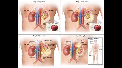 Treatment of Kidney Cancer by Stage