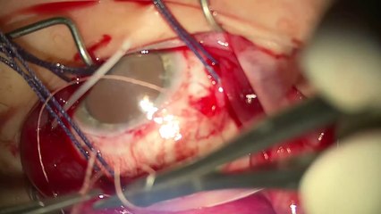 Suture of encircling buckle 220 model