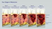 Treatment of Melanoma Skin Cancer by Stage
