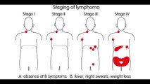 Treating B-Cell Non-Hodgkin Lymphoma