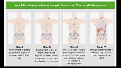 Treating Classic Hodgkin Lymphoma by Stage
