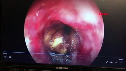 Bu hatayı sakın yapmayın! Koronavirüs sandı bakın akciğerinden ne çıktı!