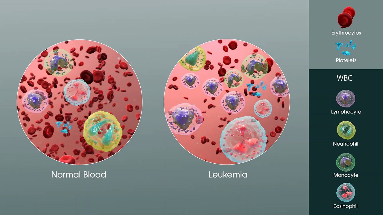 What Is Acute Lymphocytic Leukemia (ALL)