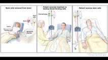 Typical Treatment of Acute Myeloid Leukemia