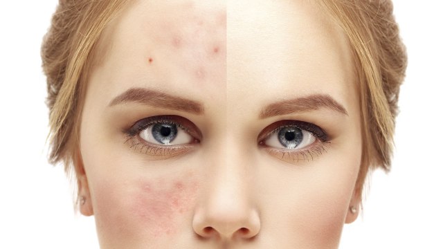 Los mejores métodos caseros para eliminar los granitos