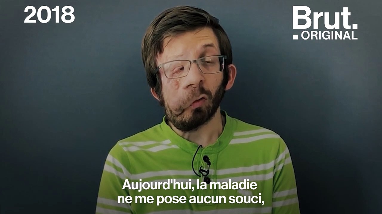 Atteint de neurofibromatose, le témoignage poignant de Guilhem