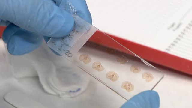 Ultrasonidos para combatir el Parkinson, un tratamiento pionero sin necesidad de cirugía
