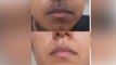 मुंह के आस-पास कालापन दूर करने का बेहद सस्‍ता तरीका । Get Rid Of Dark Patches Around The Mouth