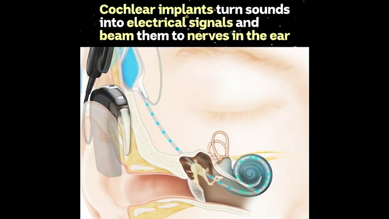 Who invented the bionic ear?