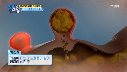 평소 변비 앓고 있는 분들 모두 주목! 변비가 OOO을 유발한다?