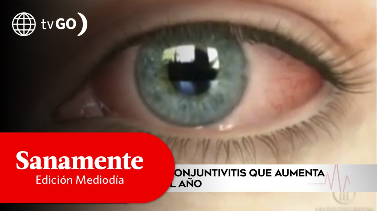 La conjuntivitis | Sanamente Edición Mediodía (HOY)