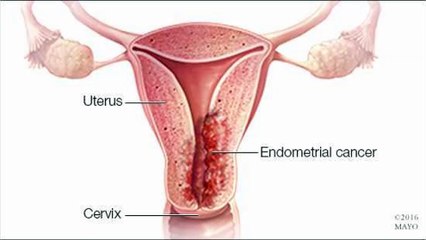 Endometrial Cancer: Symptoms, Causes & Treatment Options 🩺