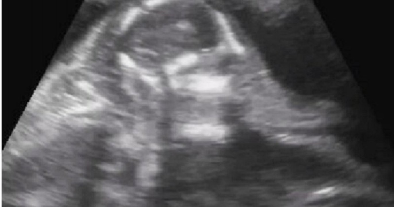 Un zoo partage l'échographie adorable d'un bébé éléphant