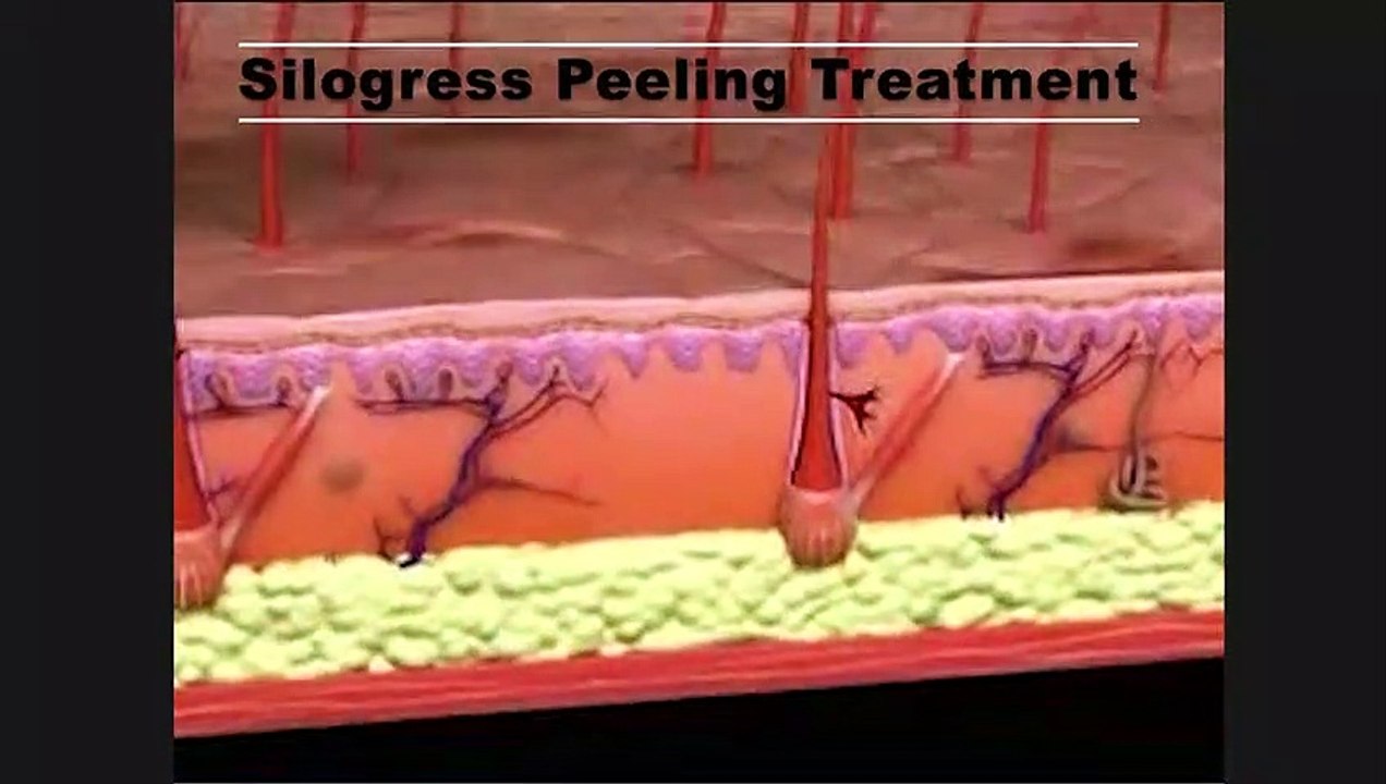 Stretch Marks Treatment