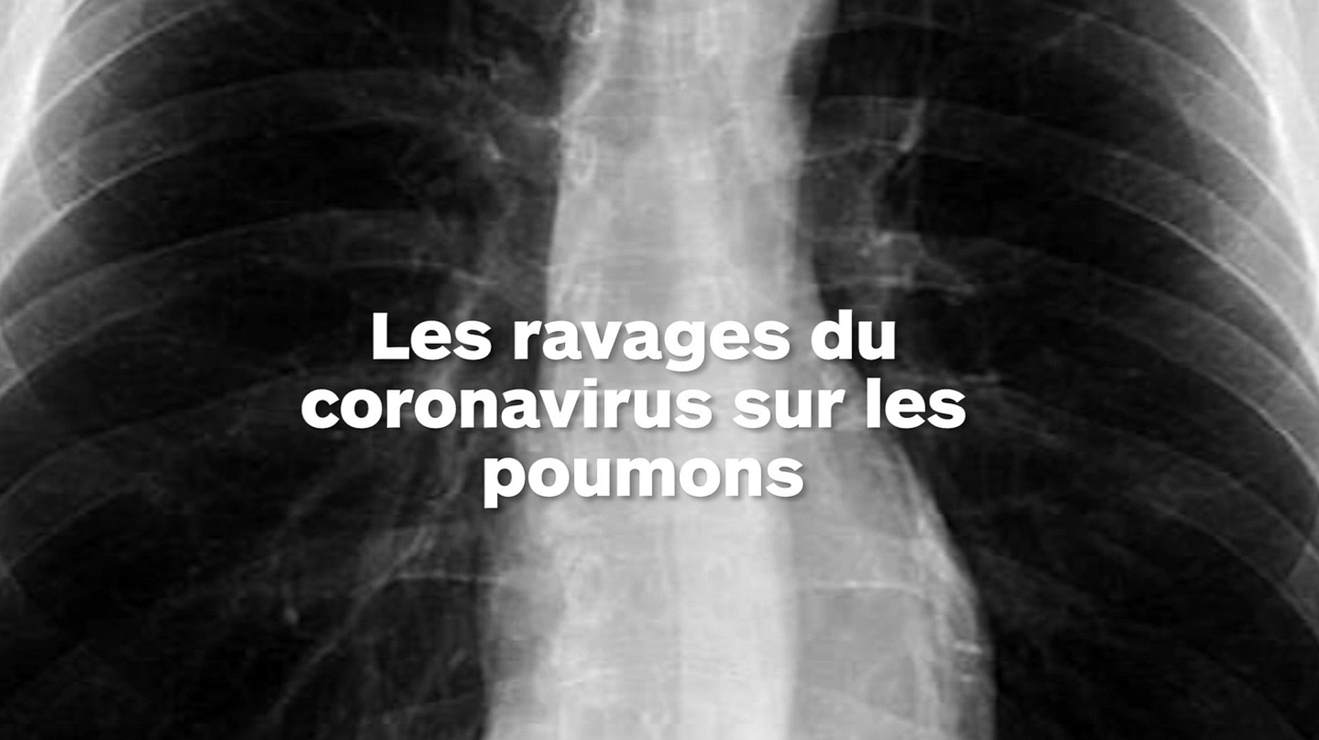 Radio Poumon Fumeur Vs Poumon Sain