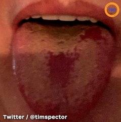 Voici un tout nouveau symptôme du Covid-19 qui toucherait la langue