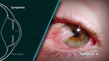 Pterygium - what is pterygium  | treatment and surgery options