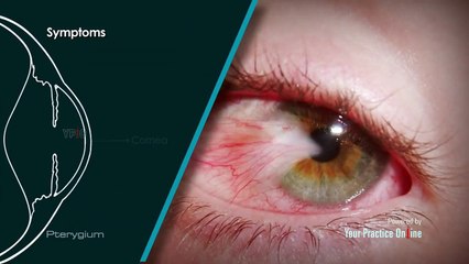 Pterygium - what is pterygium  | treatment and surgery options