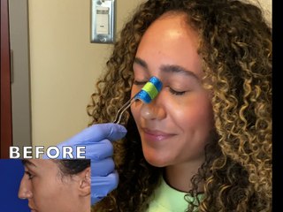 Rhinoplasty Surgery in Seattle WA