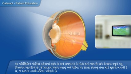 મોતિયા શું છે? ગુજરાતીમાં સરળ સમજાવો 🏥