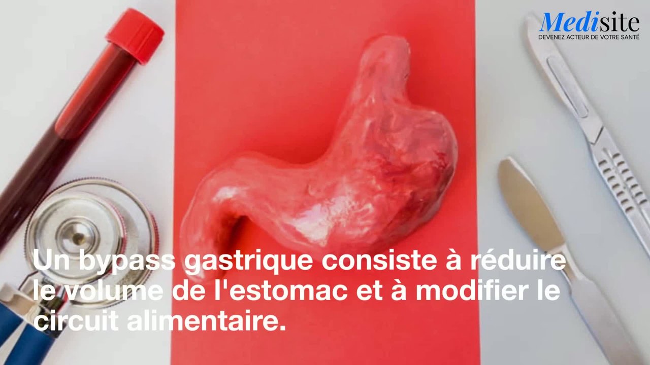 Comment le Bypass permet de mincir
