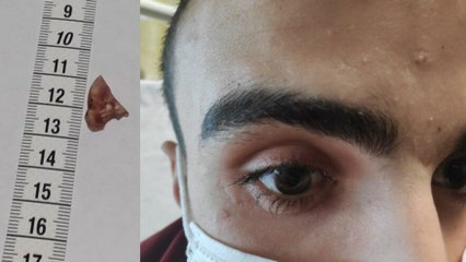 Gözünde unutulan cam kırığı kör etti