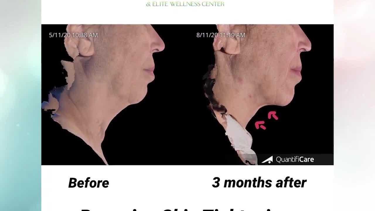 Look 10 years younger FAST with Renuvion at Adv...