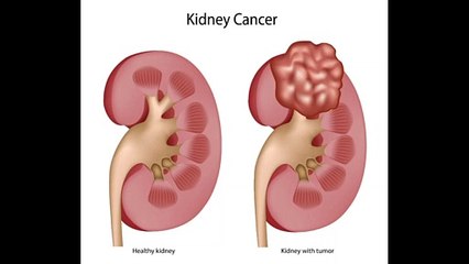 Case of Combination Cabozantinib + Nivolumab for Progressive Metastatic Renal Cell Carcinoma (mRCC)