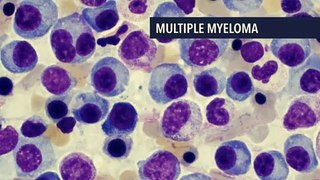 New Targets Explored for Bispecific T-Cell–Engaging Antibodies in Myeloma