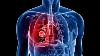 Adenocarcinoma transformation to small cell lung cancer with C797S acquire resistance to osimertinib