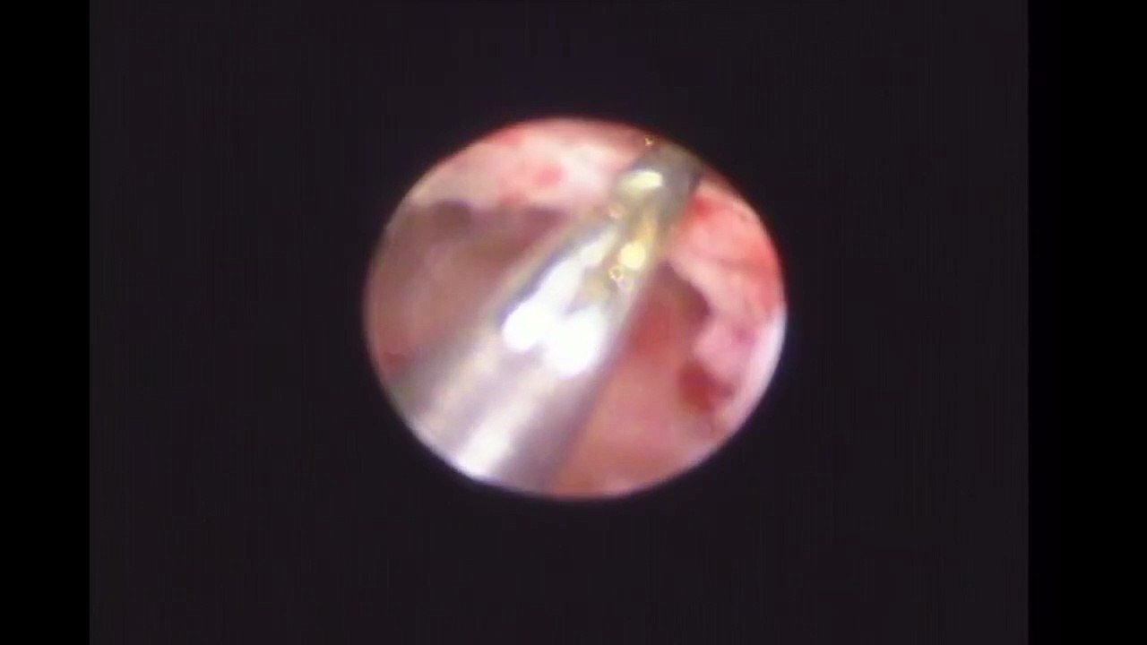 Hysteroscopic bone fragment removal | Dr Roshi Satija