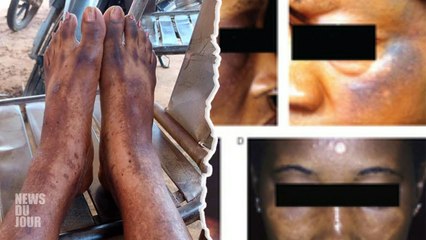 LA DEPIGMENTATION DE LA PEAU, DANGEREUSE MODE DES IVOIRIENNES