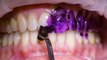 How teeth are professionally deep cleaned
