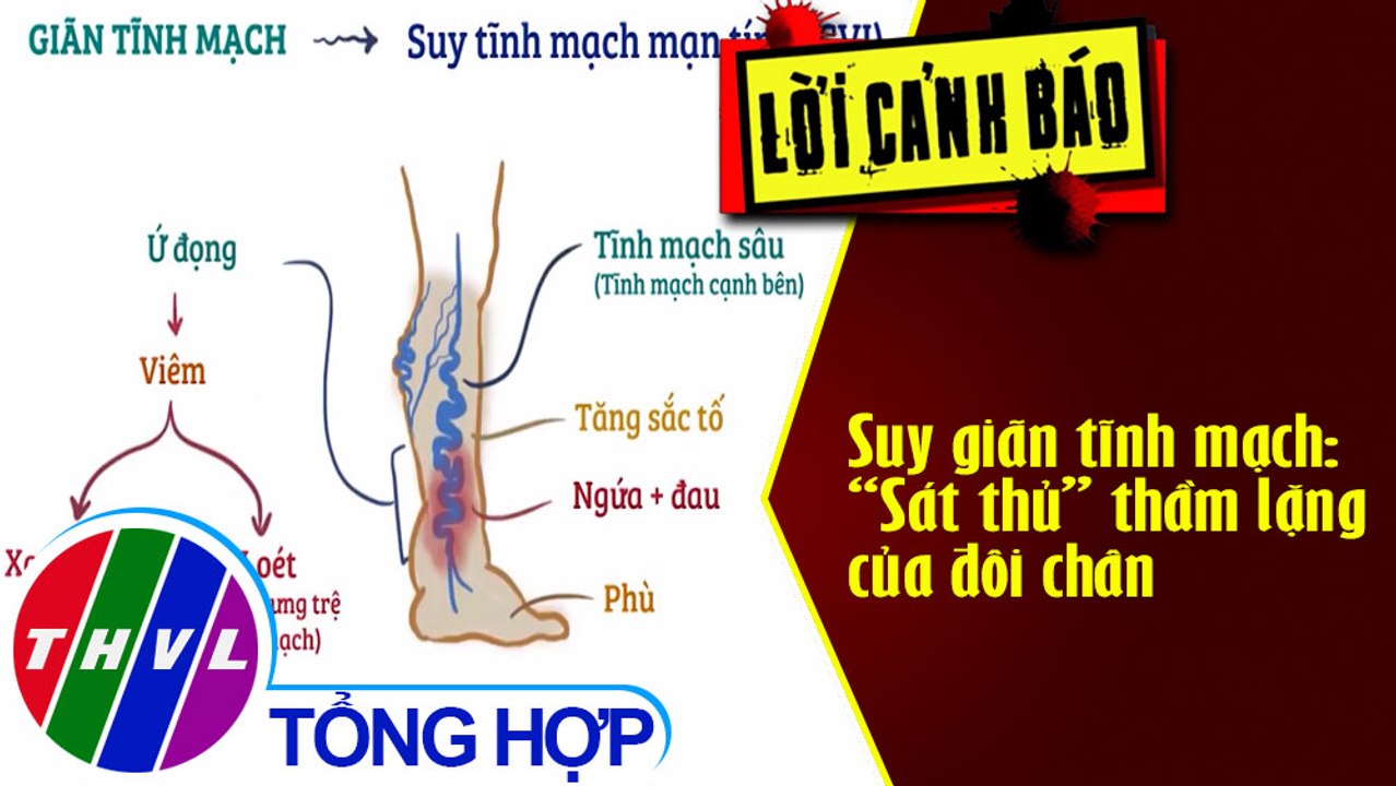Suy giãn tĩnh mạch: “Sát thủ” thầm lặng của đôi chân