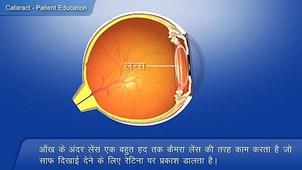 1 क्या है मोतियाबिंद? पूरी जानकारी हिंदी में 👁️