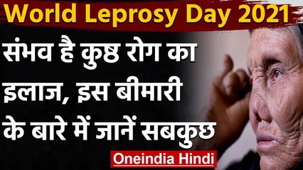 World Leprosy Day: कुष्ठ रोग के बारे में फैली हुईं भ्रातियों को जानिए | वनइंडिया हिंदी