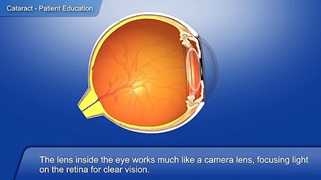 1_What is Cataract_English