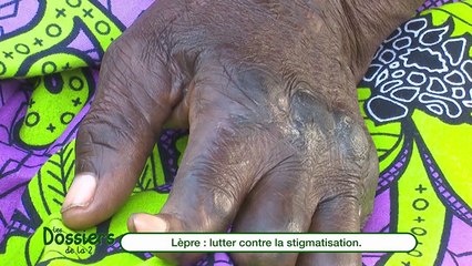 Lèpre : Lutter contre la stigmatisation