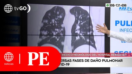 Muestran las diversas fases de daño pulmonar que causa el Covid | Primera Edición