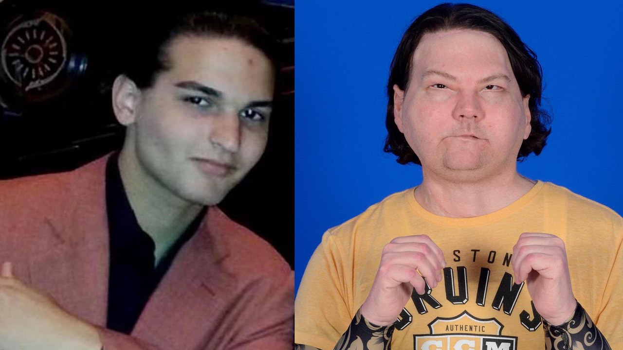 Greffé du visage et des mains après un accident de voiture, Joe DiMeo va « plutôt bien »