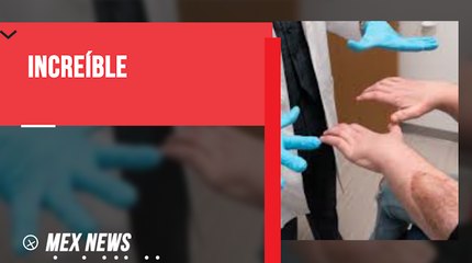 SE REALIZÓ EL PRIMER TRASPLANTE DE CARA Y MANOS EN TODA LA HISTORIA