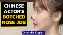 Chinese actor's botched nose job rots away tip of nose | Oneindia News
