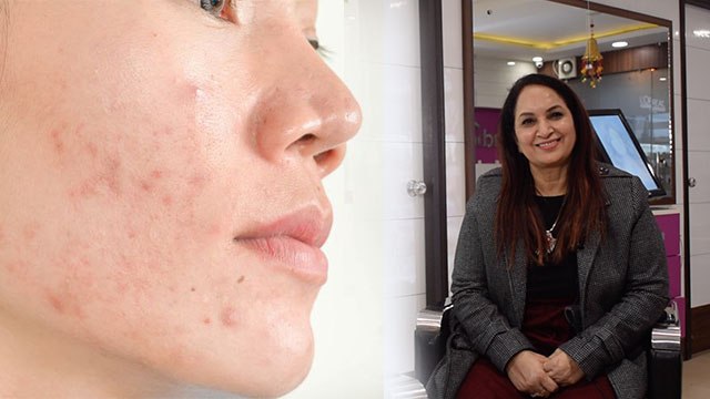 PCOD में कैसे रखें अपनी Skin का खास ख्याल, जानें Expert की सलाह; Watch Video | Boldsky