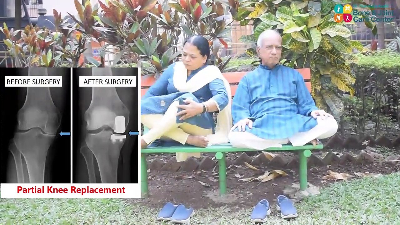 Check The Partial Knee Replacement Surgery in Maharashtra, India for Osteo arthritis of Knee Dr. Shailendra Patil