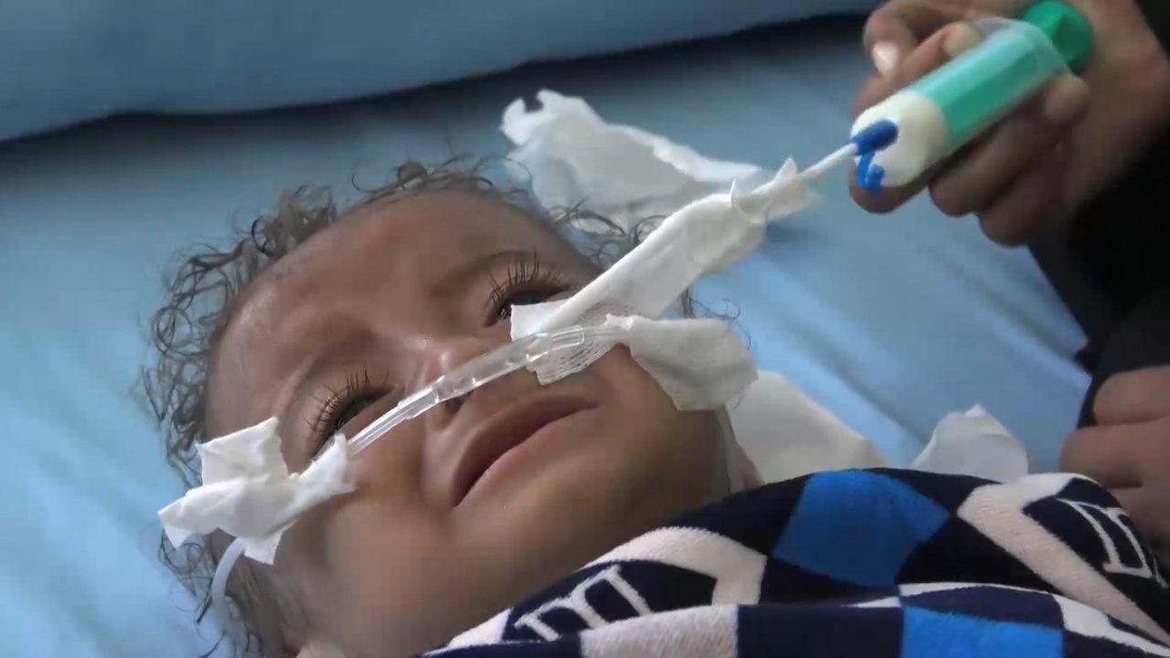 4 منظمات أممية:  نصف أطفال اليمن مهددون بسوء ال...