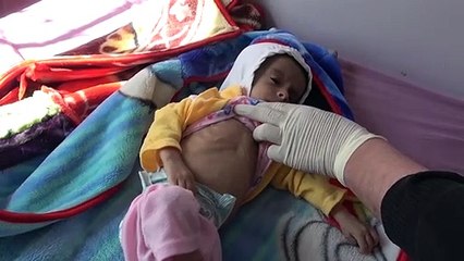 Desnutrição generalizada em crianças iemenitas