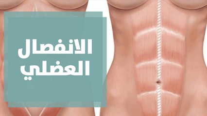 الانفصال العضلي..أسبابه وأعراضه