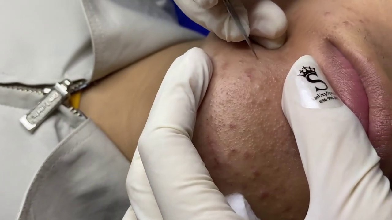 Relax Every Day - Chin Acne blackhead #1