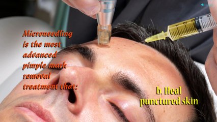 What are the Most Common Types of Acne Treatment