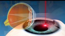 LASIK - Refractive Surgery | Understand the procedure.